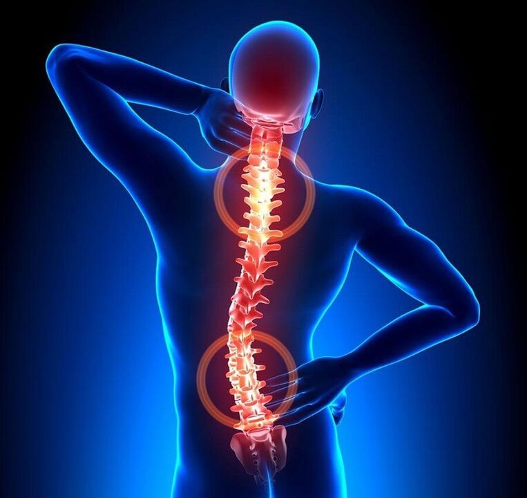 osteocondrose da coluna como causa de dor nas costas