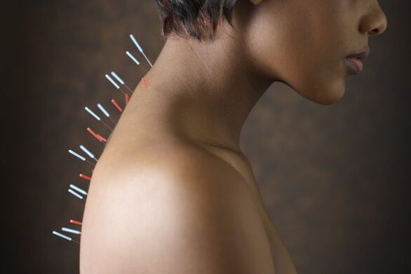 acupuntura para dor nas costas