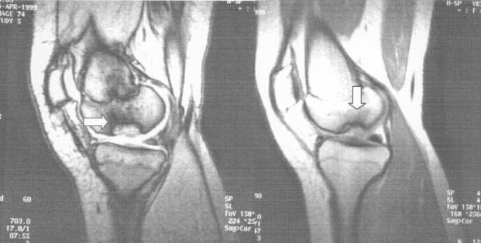 raio-x de osteocondrose dissecante na articulação do joelho