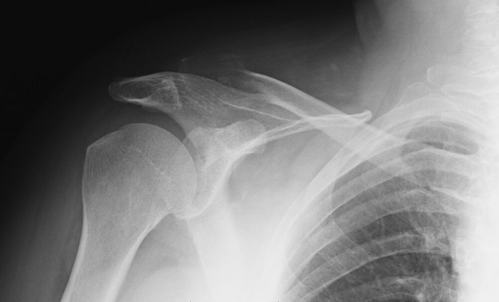 radiografia de artrose do ombro