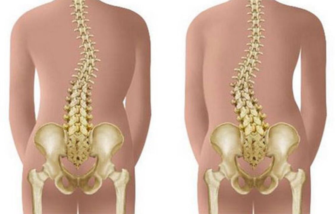 escoliose como causa de dor nas costas na área das omoplatas