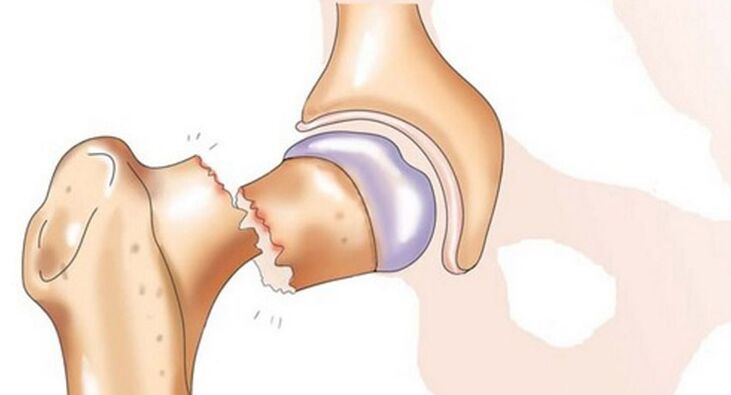 Uma fratura do colo do fêmur é acompanhada por dor intensa na articulação do quadril