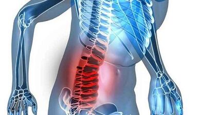 Sinais e sintomas de osteocondrose lombar